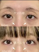 クマ治療　(裏ハムラ法) 30日後 サムネイル用
