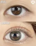 二重埋没法 before画像 サムネイル用