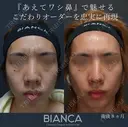 鷲鼻を忠実に再現 before画像 サムネイル用