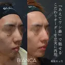 鷲鼻を忠実に再現 after画像 サムネイル用