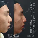 鷲鼻を忠実に再現 after画像 サムネイル用