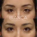 切らない眼瞼下垂（タッキング法） before画像 サムネイル用