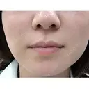 M字リップ形成 before画像 サムネイル用