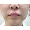 M字リップ形成 after画像 サムネイル用