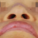 クレオパトラノーズ before画像 サムネイル用