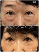 表ハムラ👀 after画像 サムネイル用