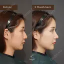 鼻骨骨切り＋ハンプ削り＋鼻中隔延長＋鼻尖形成 (耳介軟骨) after画像 サムネイル用