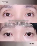 脂肪注入(目の上) before画像 サムネイル用
