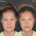 糸リフト12本＋ヒアルロン酸4本＋ベビーコラーゲン1.0cc  before画像 サムネイル用