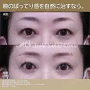 眉下切開、ROOF切除 before画像 サムネイル用
