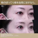 眉下切開、ROOF切除 after画像 サムネイル用