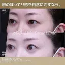 眉下切開、ROOF切除 after画像 サムネイル用
