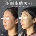 小顔脂肪吸引 90日後 サムネイル用