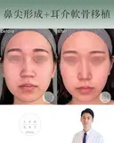 鼻尖形成＋耳介軟骨移植 before画像 サムネイル用