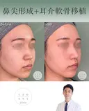 鼻尖形成＋耳介軟骨移植 after画像 サムネイル用