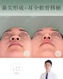 鼻尖形成＋耳介軟骨移植 after画像 サムネイル用