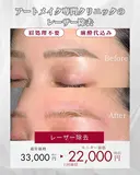 アートメイク除去・トーニング after画像 サムネイル用