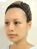 鼻プロテーゼ抜去+後日隆鼻術（生体内再生医療） before画像 サムネイル用