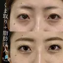 くま取り＋脂肪注入 after画像 サムネイル用