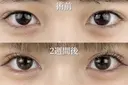 二重埋没法 before画像 サムネイル用