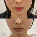 エラボトックス after画像 サムネイル用