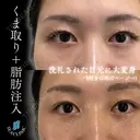 くま取り＋脂肪注入 before画像 サムネイル用