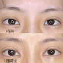 ☘️目頭切開☘️ after画像 サムネイル用