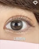 二重埋没法 7日後 サムネイル用