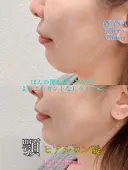 顎ヒアルロン酸 before画像 サムネイル用