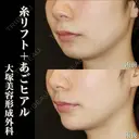 糸リフト+あごヒアルロン酸注入 after画像 サムネイル用
