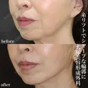 糸リフト after画像 サムネイル用