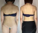 上腕全周脂肪吸引 before画像 サムネイル用