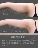 どこから見ても華奢な腕に！｜二の腕のベイザー脂肪吸引 before画像 サムネイル用