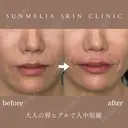 大人の唇ヒアルで人中短縮 before画像 サムネイル用