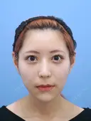 アキーセル脂肪吸引(頬・あご下)+プリマリフト＋バッカルファット＋額・頬の脂肪注入＋眼瞼下垂＋目頭切開＋目の下のたるみ取り＋鼻中隔延長＋鼻プロテーゼ＋わし鼻修正　2ヶ月後のお写真 60日後 サムネイル用