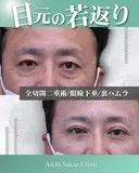 眼瞼下垂、全切開、裏ハムラ before画像 サムネイル用