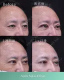 眼瞼下垂、全切開、裏ハムラ after画像 サムネイル用