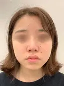 脂肪吸引(頬・顎下)/バッカルファット除去/エラボトックス   before画像 サムネイル用