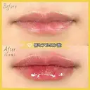唇のヒアルロン酸注射 before画像 サムネイル用