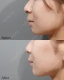 Eライン形成 before画像 サムネイル用
