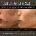 ダーマペン before画像 サムネイル用