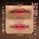 M字リップ形成術＋スマートリップ(たらこ唇整形)＋口角挙上 before画像 サムネイル用