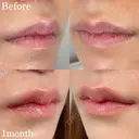 M字リップ形成術 before画像 サムネイル用