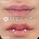 M字リップ形成術 after画像 サムネイル用