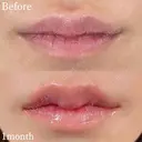 M字リップ形成術 after画像 サムネイル用