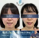 3D脂肪吸引（頬）/ジョールファット除去  /バッカルファット除去 /糸リフトエラボトックス before画像 サムネイル用