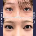 綺麗になる🦋 ネビュラクリニックの目の下のクマ取り💫 before画像 サムネイル用