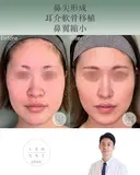 鼻尖形成+耳介軟骨移植+鼻翼縮小 after画像 サムネイル用