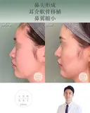 鼻尖形成+耳介軟骨移植+鼻翼縮小 after画像 サムネイル用