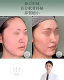 鼻尖形成+耳介軟骨移植+鼻翼縮小 after画像 サムネイル用